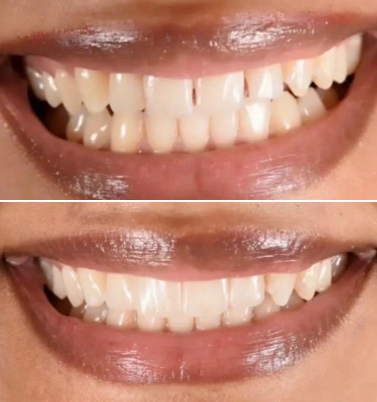 Before and after smile showing teeth whitening and cosmetic enhancement results